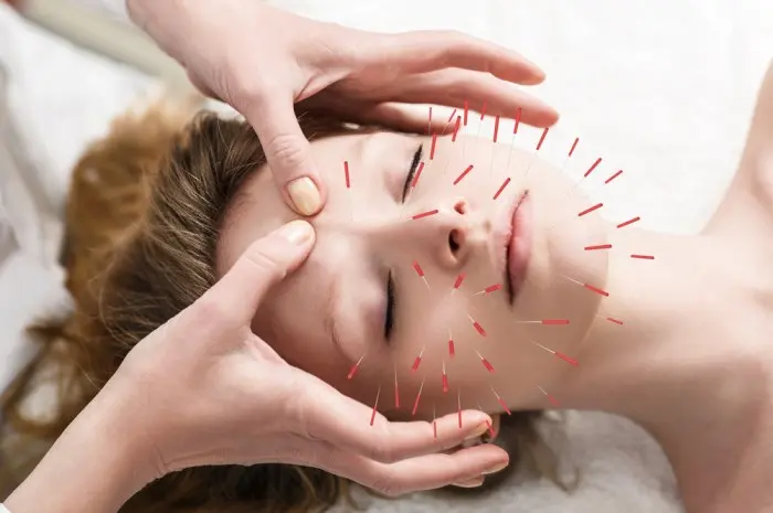 7 Manfaat Kecantikan & Kesehatan Akupunktur Kosmetik